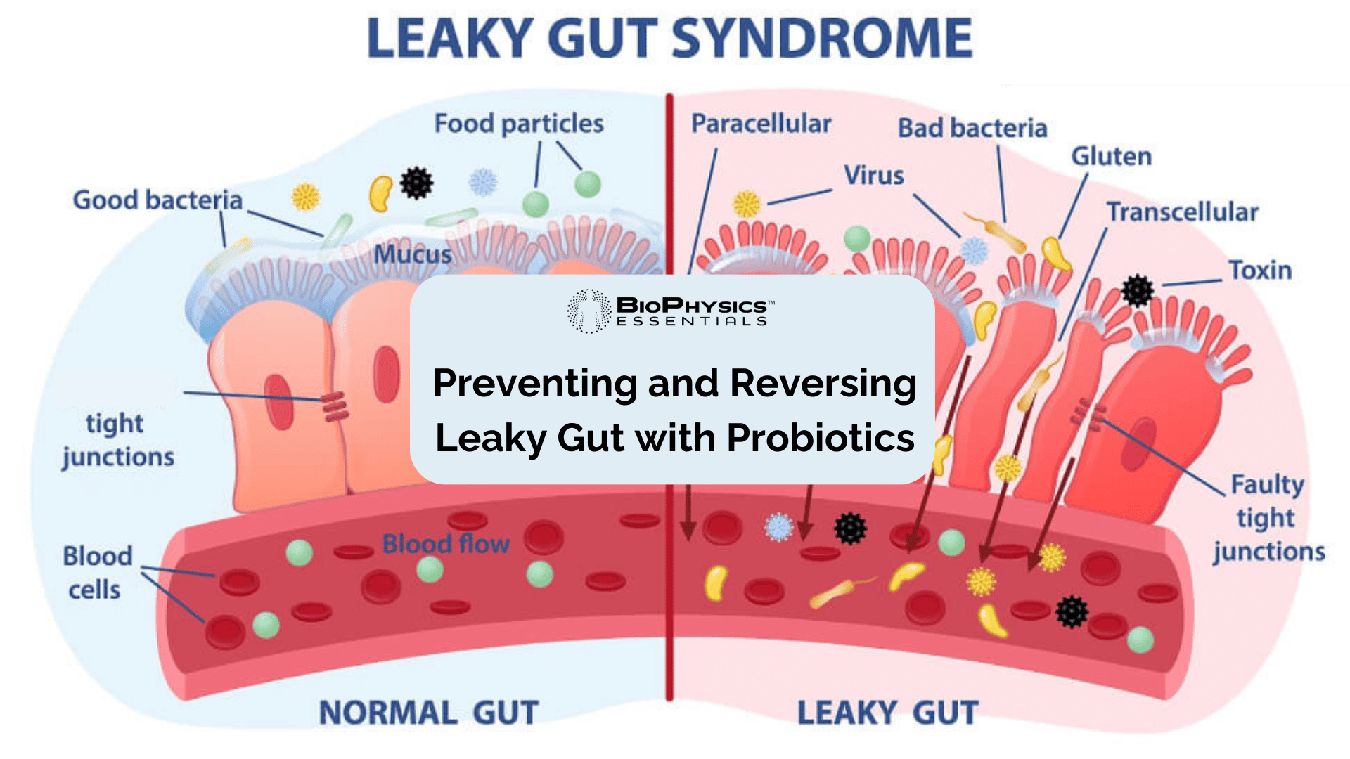 Strengthening the Gut Barrier: Preventing and Reversing Leaky Gut with Probiotics