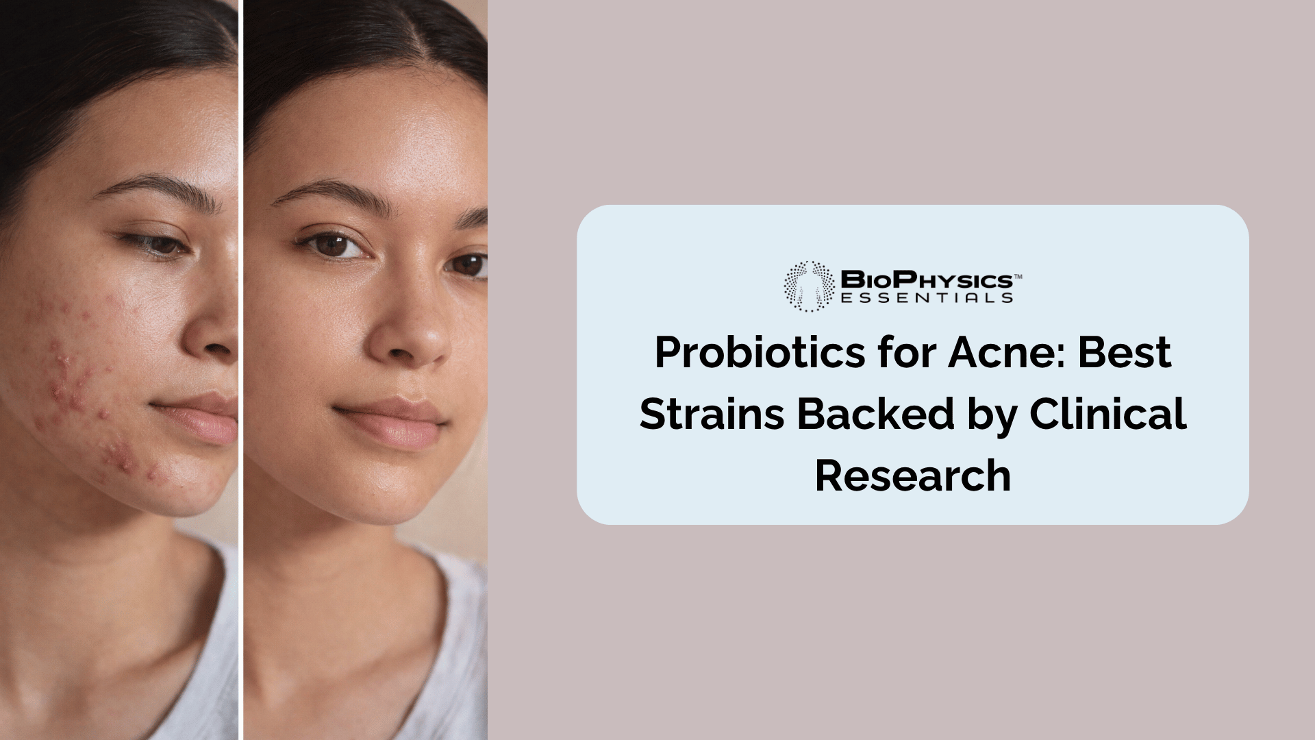 Split-screen editorial image showing a before and after comparison of a woman's skin — potential benefits of probiotic supplementation for acne vulgaris